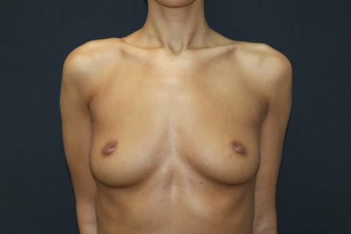 Patient before post weight loss skin removal surgery