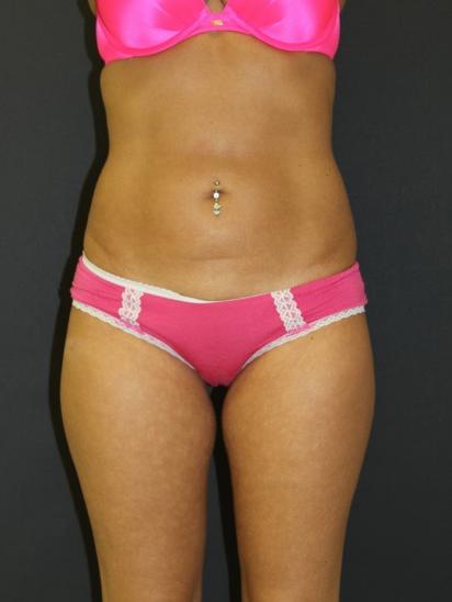 Patient before post weight loss body contouring surgery