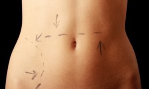 Tummy Tuck Atlantic County