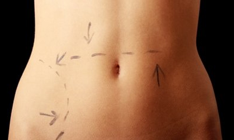 How Long is Recovery from a Tummy Tuck? | Atlantic County & Toms River | Cornerstone Plastic Surgery Tummy Tuck Atlantic County