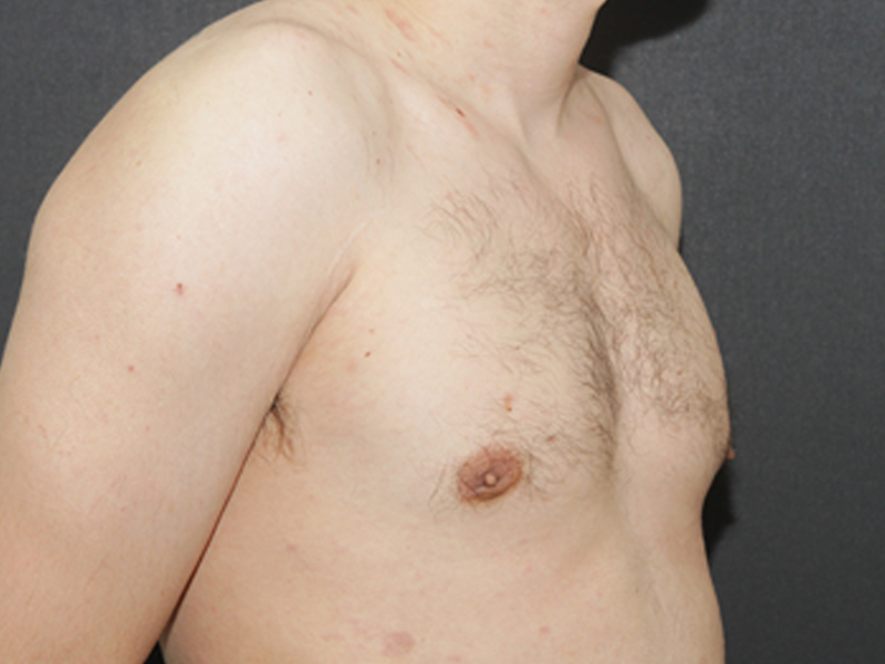 Gynecomastia Atlantic County