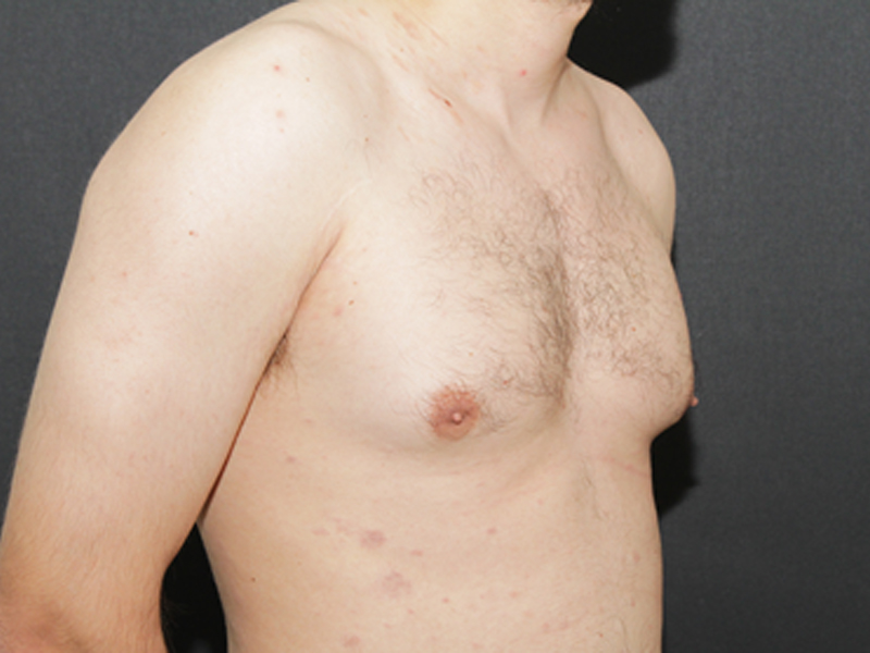 Gynecomastia Atlantic County