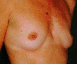 Before Breast Augmentation Linwood
