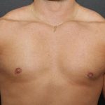 Gynecomastia Case 6091, After Treatment, Male Patient, Thumbnail 1