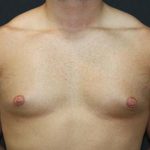 Gynecomastia Case 6091, Before Treatment, Male Patient, Thumbnail 1