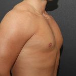 Gynecomastia Case 6091, After Treatment, Male Patient, Thumbnail 2