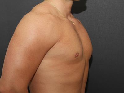 Gynecomastia Case 6091, After Treatment, Male Patient, Set 2