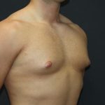 Gynecomastia Case 6091, Before Treatment, Male Patient, Thumbnail 2