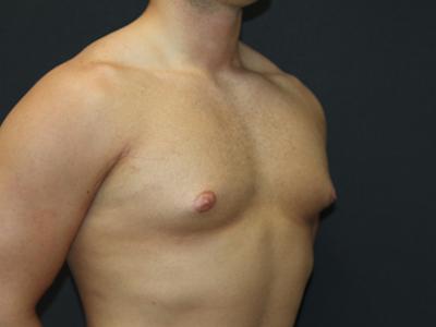 Gynecomastia Case 6091, Before Treatment, Male Patient, Set 2