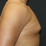 Gynecomastia Case 6091, Before Treatment, Male Patient, Thumbnail 3