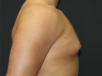 Gynecomastia Case 6091, Before Treatment, Male Patient, Set 3
