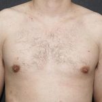 Gynecomastia Case 6092, After Treatment, Male Patient, Thumbnail 1