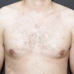 Gynecomastia Case 6092, Before Treatment, Male Patient, Thumbnail 1