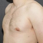 Gynecomastia Case 6092, After Treatment, Male Patient, Thumbnail 4