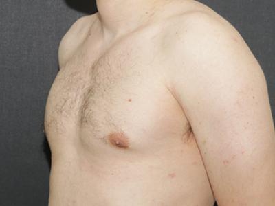 Gynecomastia Case 6092, After Treatment, Male Patient, Set 4