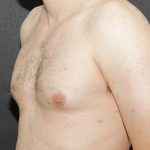 Gynecomastia Case 6092, Before Treatment, Male Patient, Thumbnail 4