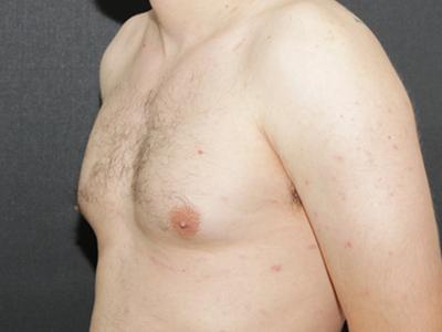 Gynecomastia Case 6092, Before Treatment, Male Patient, Set 4