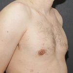 Gynecomastia Case 6092, After Treatment, Male Patient, Thumbnail 2
