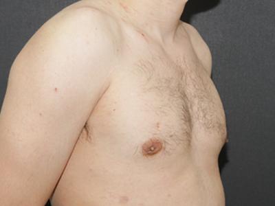Gynecomastia Case 6092, After Treatment, Male Patient, Set 2