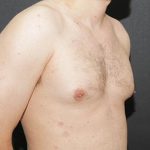 Gynecomastia Case 6092, Before Treatment, Male Patient, Thumbnail 2