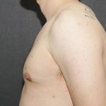 Gynecomastia Case 6092, After Treatment, Male Patient, Thumbnail 5