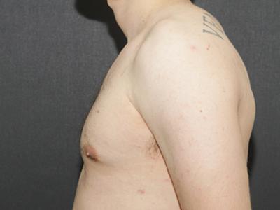 Gynecomastia Case 6092, After Treatment, Male Patient, Set 5