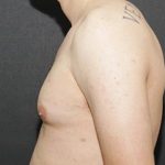Gynecomastia Case 6092, Before Treatment, Male Patient, Thumbnail 5