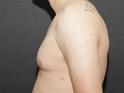 Gynecomastia Case 6092, Before Treatment, Male Patient, Set 5