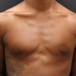 Gynecomastia Case 6093, After Treatment, Male Patient, Thumbnail 1