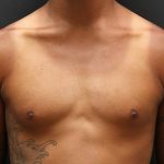 Gynecomastia Case 6093, Before Treatment, Male Patient, Thumbnail 1