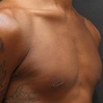 Gynecomastia Case 6093, After Treatment, Male Patient, Thumbnail 2
