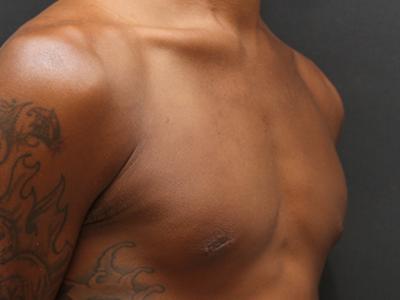 Gynecomastia Case 6093, After Treatment, Male Patient, Set 2