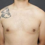 Gynecomastia Case 6094, After Treatment, Male Patient, Thumbnail 1