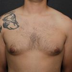 Gynecomastia Case 6094, Before Treatment, Male Patient, Thumbnail 1