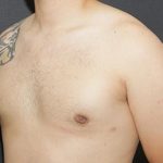 Gynecomastia Case 6094, After Treatment, Male Patient, Thumbnail 2