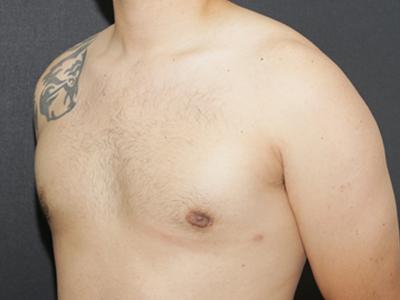 Gynecomastia Case 6094, After Treatment, Male Patient, Set 2