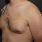 Gynecomastia Case 6094, Before Treatment, Male Patient, Thumbnail 2