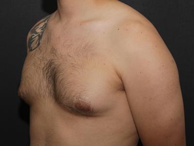 Gynecomastia Case 6094, Before Treatment, Male Patient, Set 2