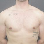 Gynecomastia Case 6095, After Treatment, Male Patient, Thumbnail 1
