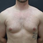 Gynecomastia Case 6095, Before Treatment, Male Patient, Thumbnail 1