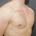 Gynecomastia Case 6095, After Treatment, Male Patient, Thumbnail 2