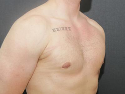 Gynecomastia Case 6095, After Treatment, Male Patient, Set 2