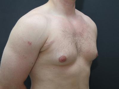 Gynecomastia Case 6095, Before Treatment, Male Patient, Set 2