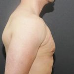 Gynecomastia Case 6095, After Treatment, Male Patient, Thumbnail 3