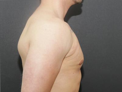 Gynecomastia Case 6095, After Treatment, Male Patient, Set 3