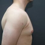 Gynecomastia Case 6095, Before Treatment, Male Patient, Thumbnail 3
