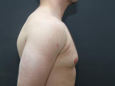 Gynecomastia Case 6095, Before Treatment, Male Patient, Set 3
