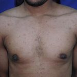 Gynecomastia Case 6096, After Treatment, Male Patient, Thumbnail 1