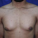 Gynecomastia Case 6096, Before Treatment, Male Patient, Thumbnail 1