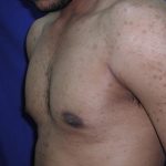 Gynecomastia Case 6096, After Treatment, Male Patient, Thumbnail 2